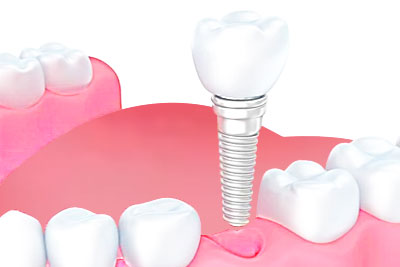 即刻種植（immediate implant placement）技術(shù)